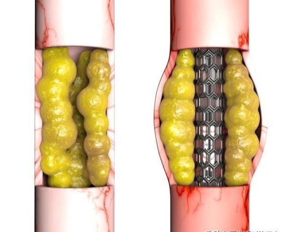 心脏支架手术后能活多久？医生告诉你真相