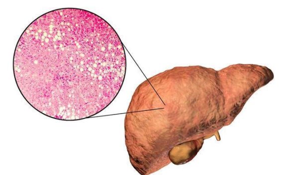 脂肪肝不仅是肝脏的事，补肝补脾补肾才是关键